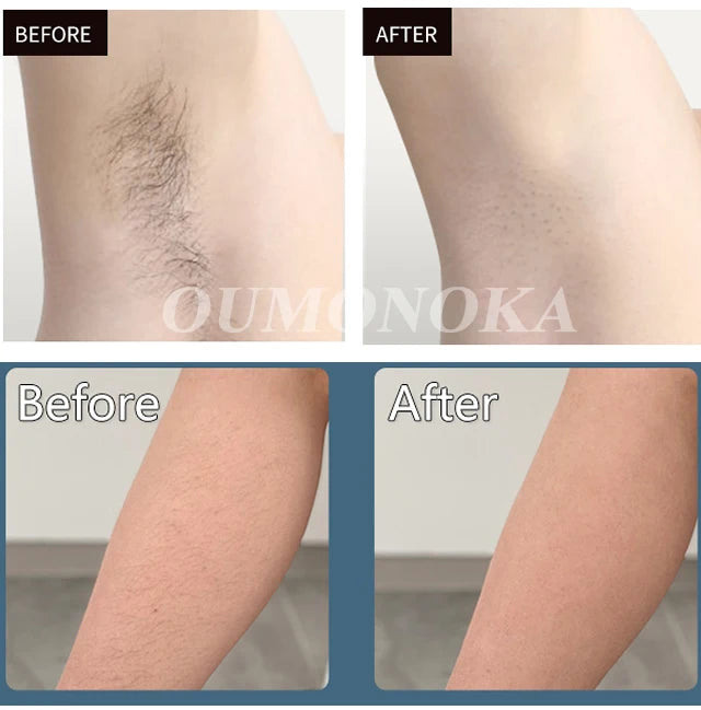 "Aparelho de Depilação Profissional IPL/Laser para Uso Caseiro – Resultados Permanentes e Indolores para Mulheres e Homens"