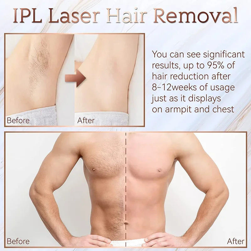 "Aparelho de Depilação Profissional IPL/Laser para Uso Caseiro – Resultados Permanentes e Indolores para Mulheres e Homens"