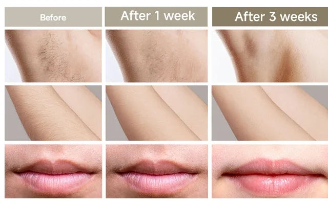 "Aparelho de Depilação Profissional IPL/Laser para Uso Caseiro – Resultados Permanentes e Indolores para Mulheres e Homens"